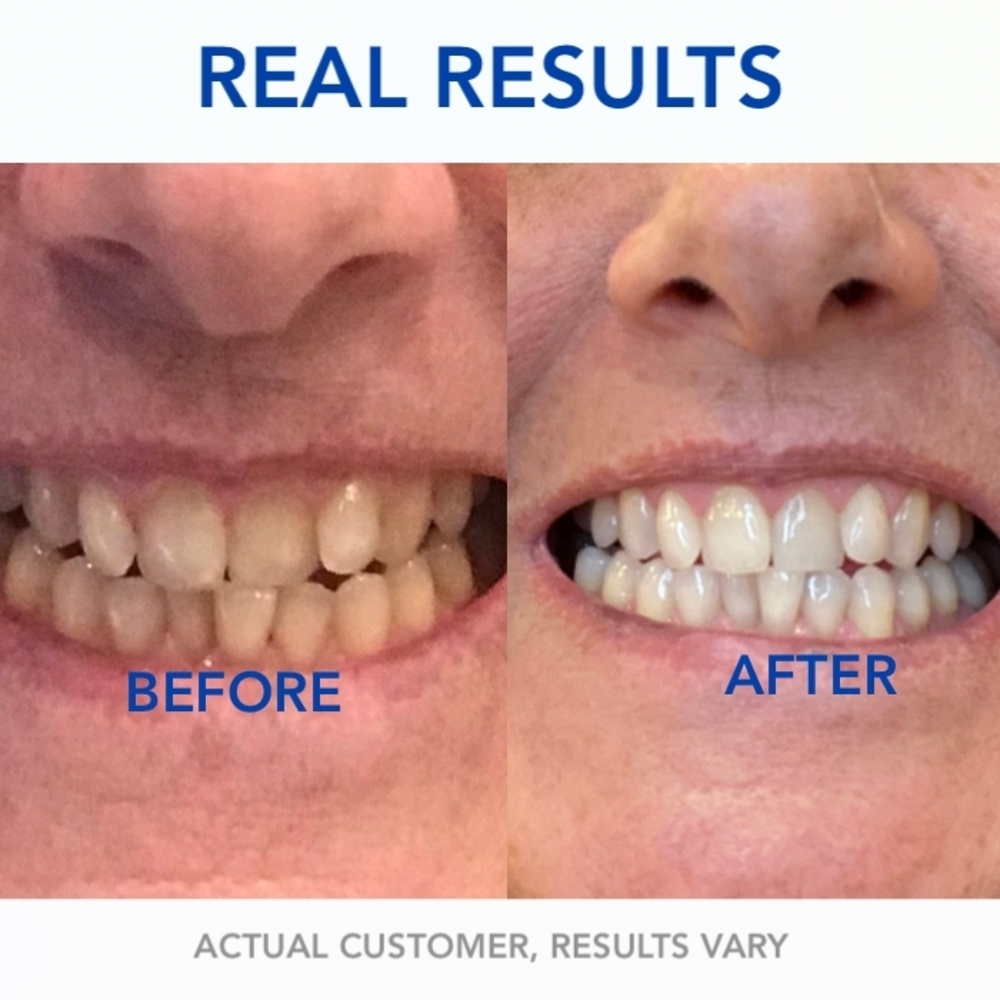 Purple Teeth Whitening Kit - Picture 13 of 15